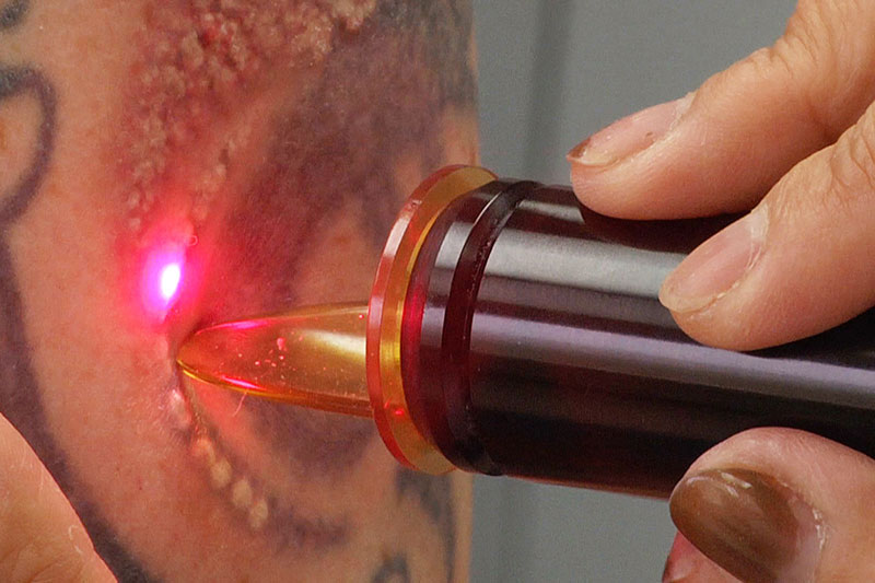 Eliminar tatuaje laser